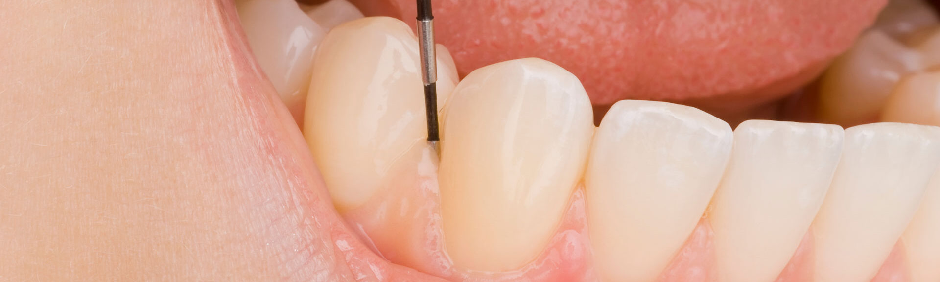 定期健診について｜西中歯科医院