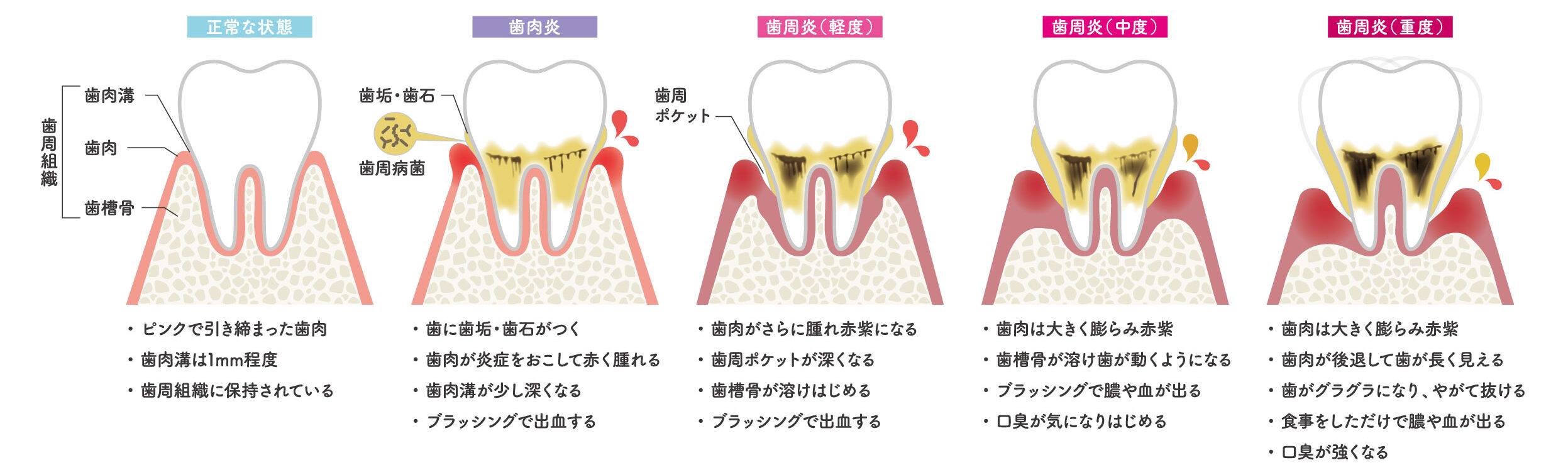 歯周病治療とは